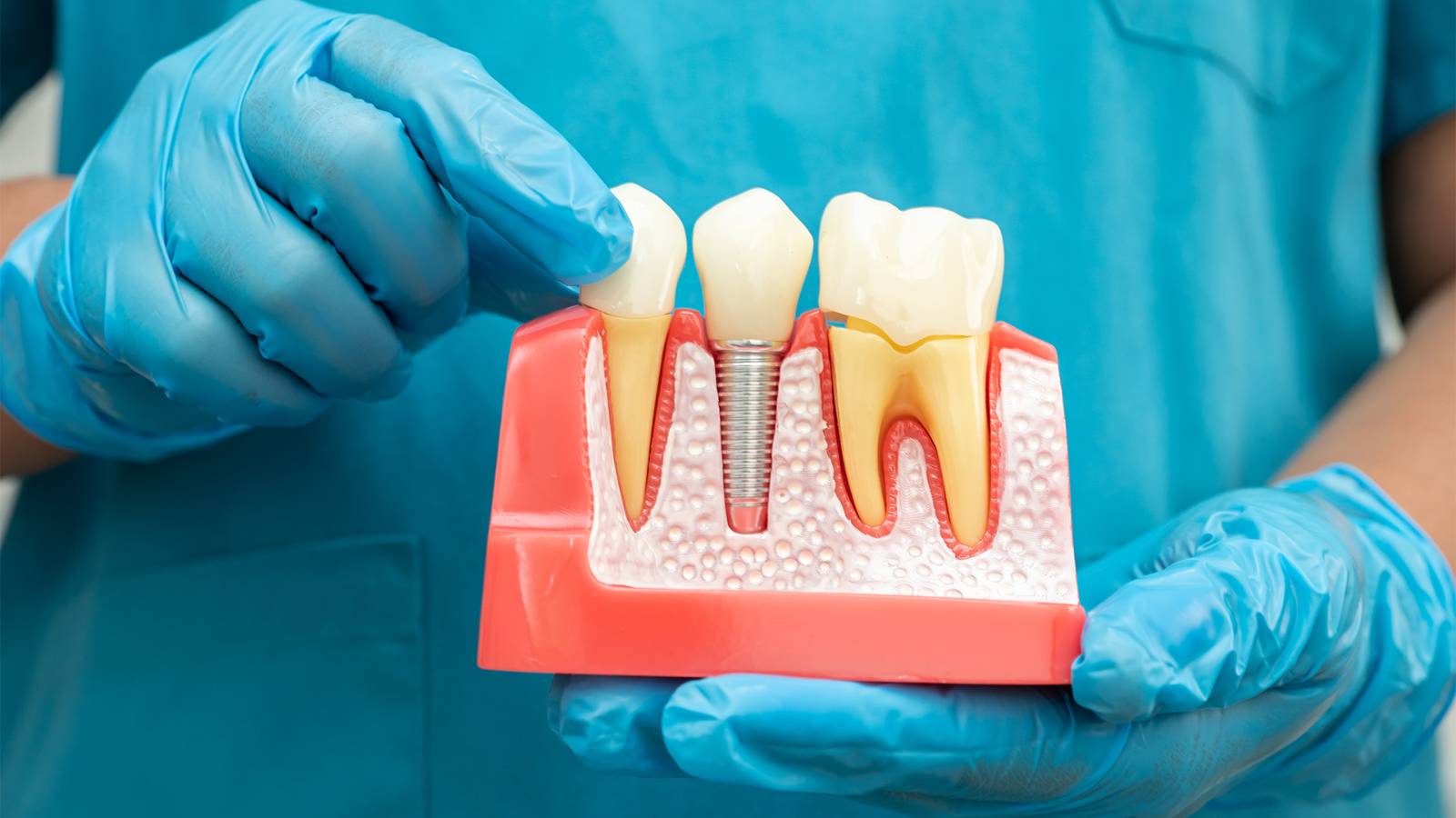 Straumann-Implantat